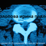 грыжа диска L4-L5