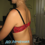 Лечение кифоза поясничного отдела 1 004