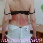 сколиоз
