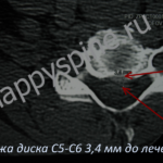 грыжа диска С5-С6