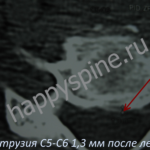 грыжа диска С5-С6