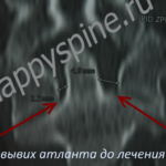грыжа диска С5-С6