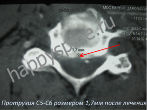 грыжа диска С3-С4