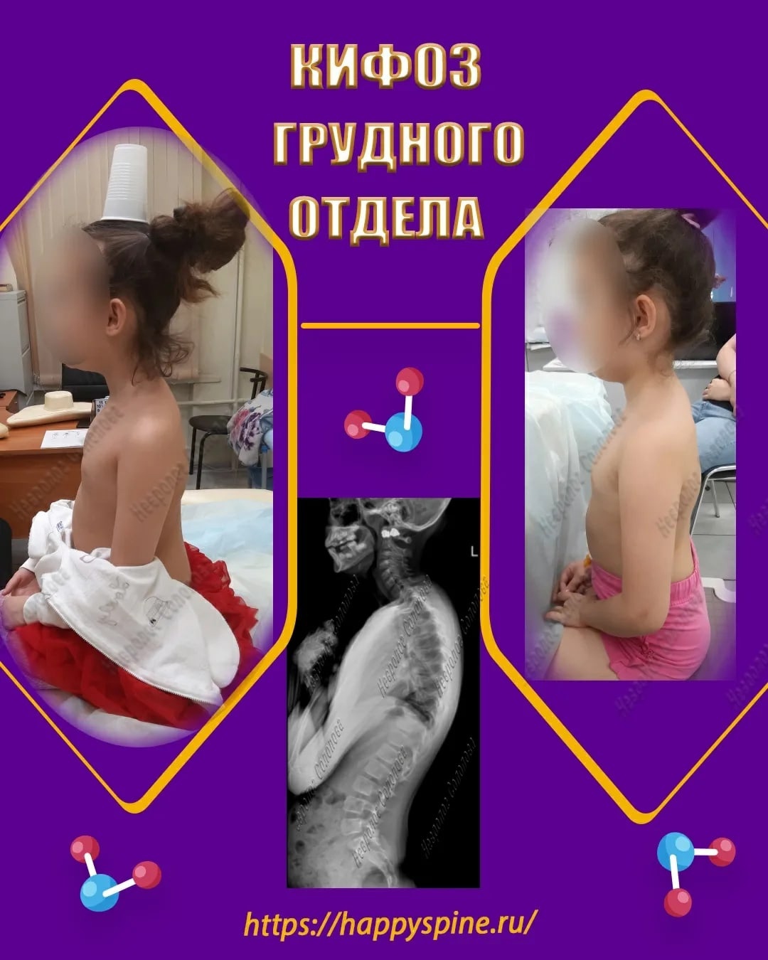 позвоночника у ребенка1