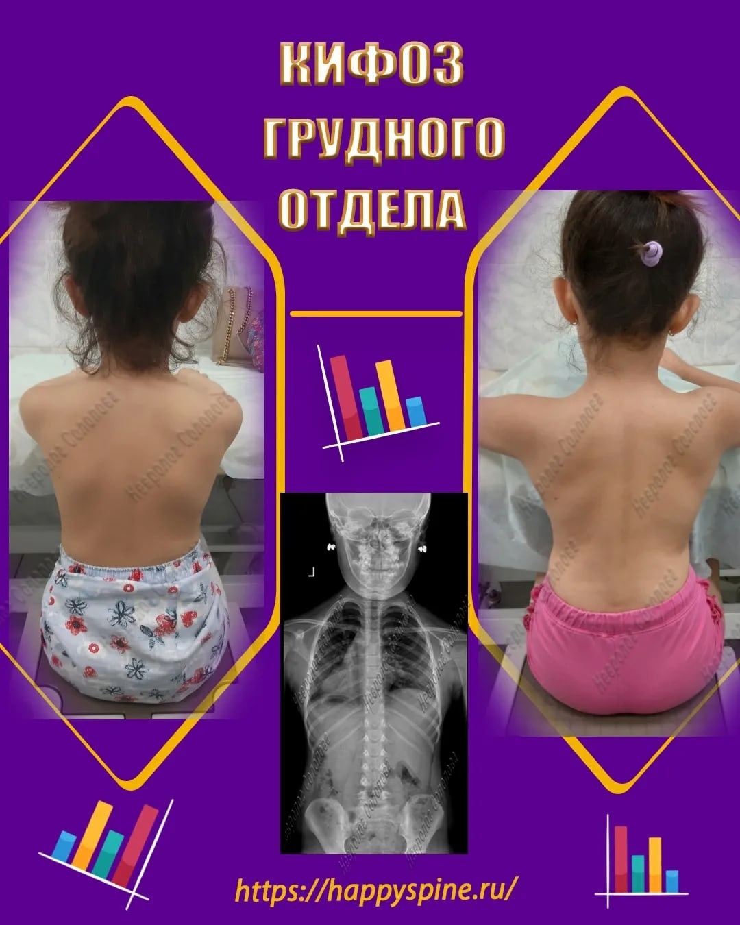 позвоночника у ребенка2
